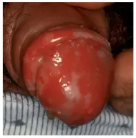 Sintomas De Herpes En Los Hombres