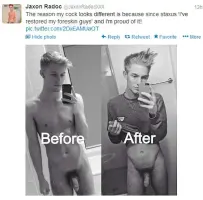 Jaxon Radoc Foreskin Restoration